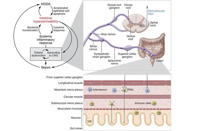 Multiorgan failure &#8211; Multiorgan dysfunction syndrome (MODS)