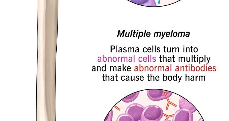 Multiple myeloma is confused with many diseases