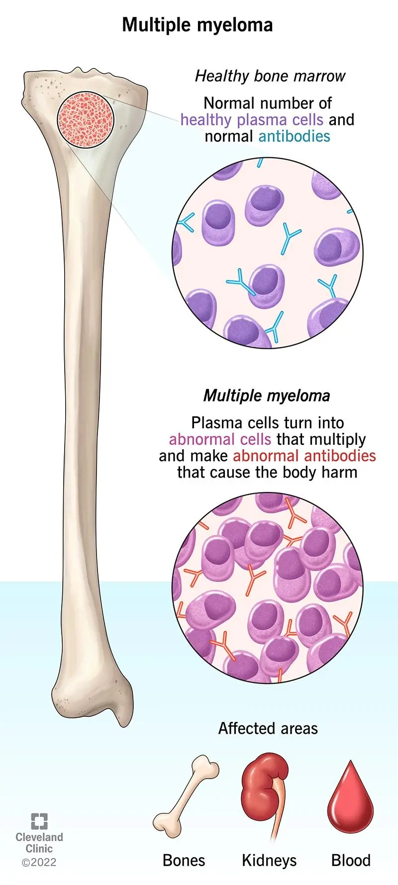 Multiple myeloma is confused with many diseases