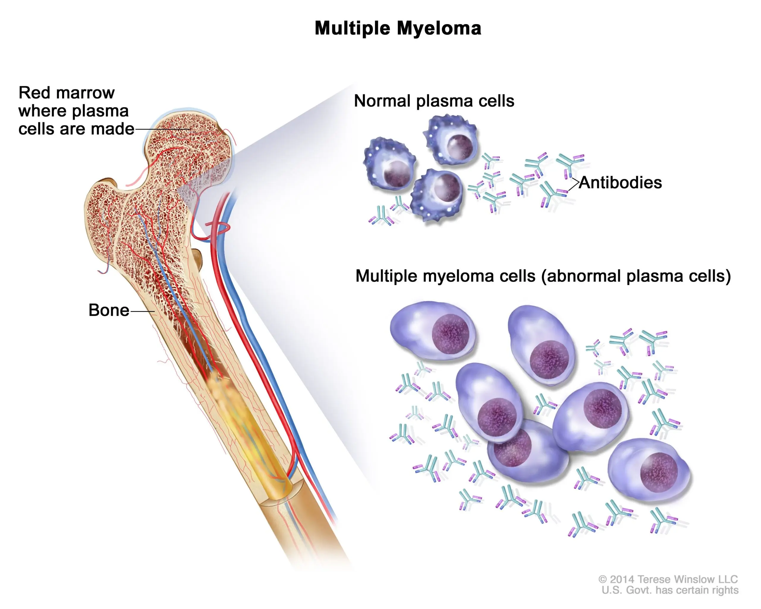 Multiple Myeloma &#8211; What is it? [WE EXPLAIN]