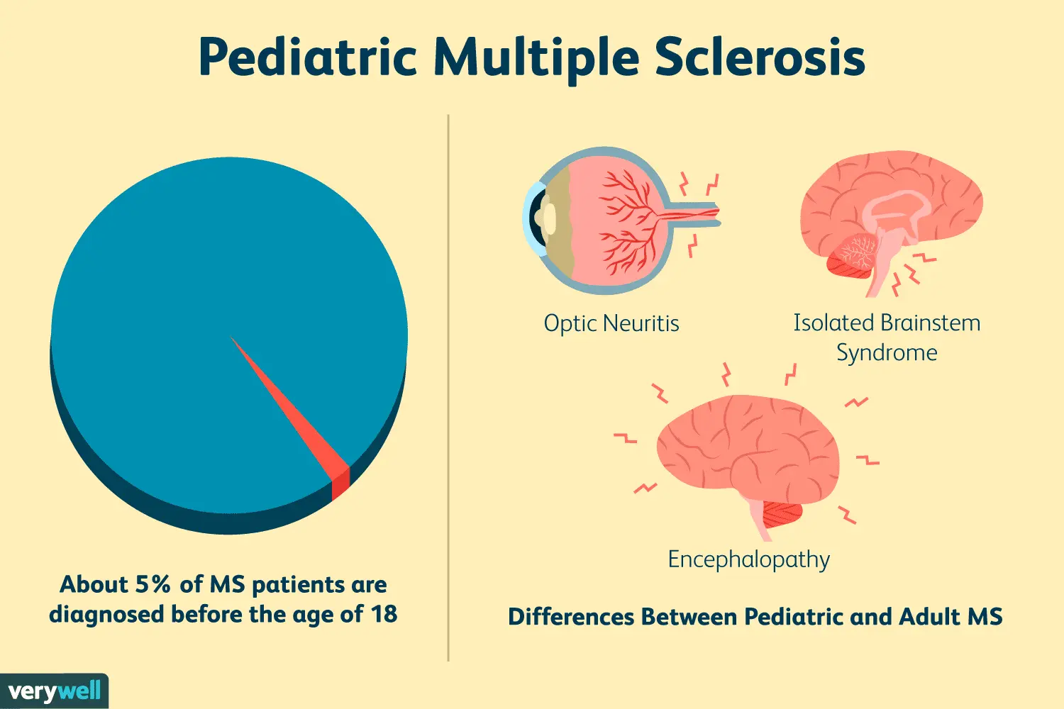 Multiple sclerosis in children