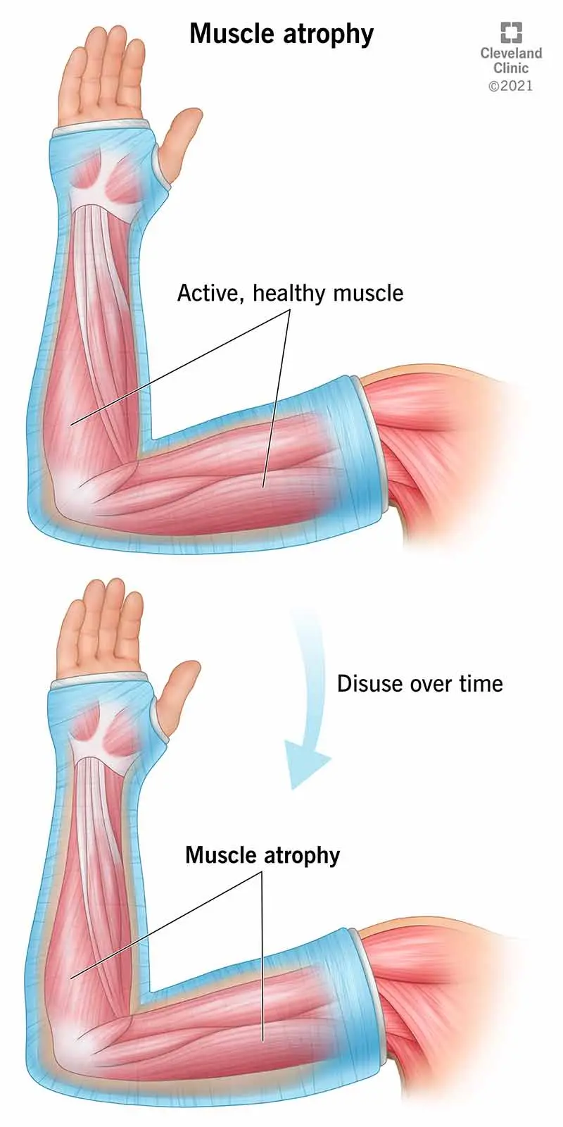 Muscle atrophy &#8211; Causes and Symptoms