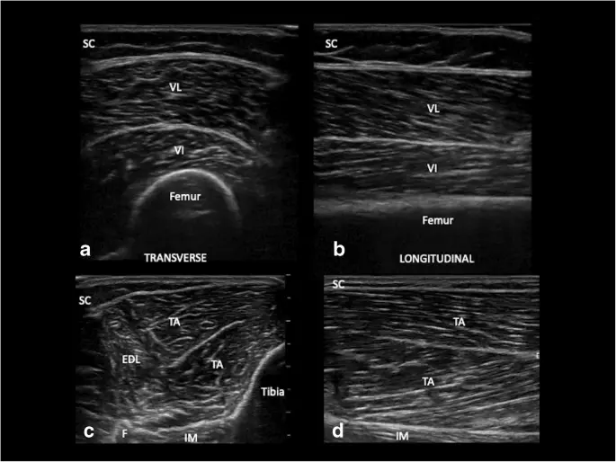 Muscle ultrasound &#8211; when to perform and what does the examination look like?