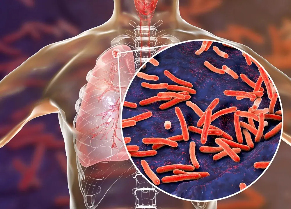 Mycobacteria strike back. Tuberculosis more dangerous than ever?