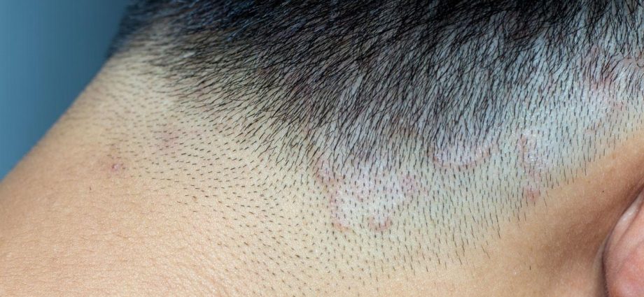 Mycosis of the scalp &#8211; symptoms and treatment