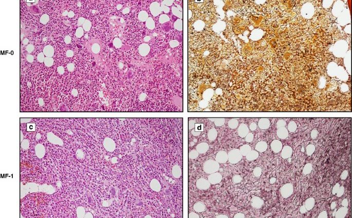 Myelofibrosis, or bone marrow fibrosis