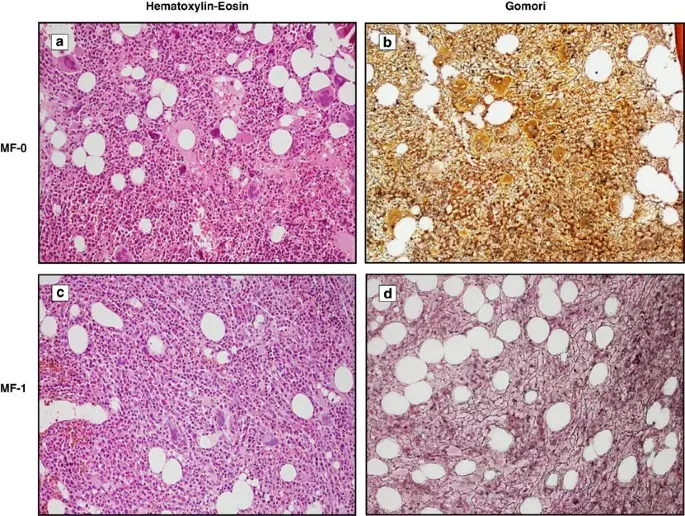 Myelofibrosis, or bone marrow fibrosis