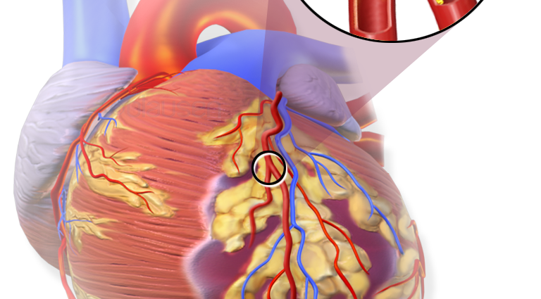 Myocardial infarction