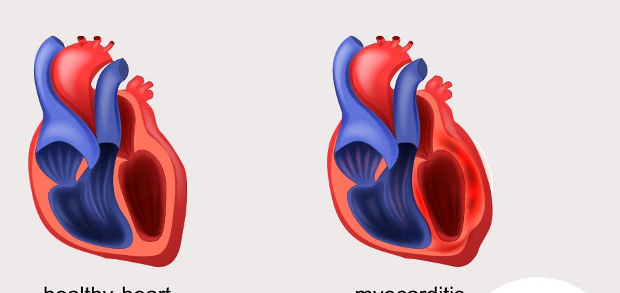 Myocarditis &#8211; causes, symptoms, treatment