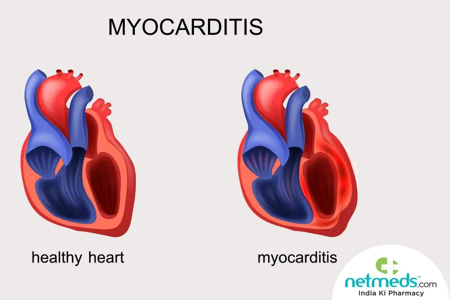 Myocarditis &#8211; causes, symptoms, treatment