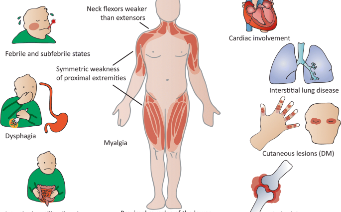 Myopathy &#8211; Causes and Symptoms. What is the treatment of myopathy?