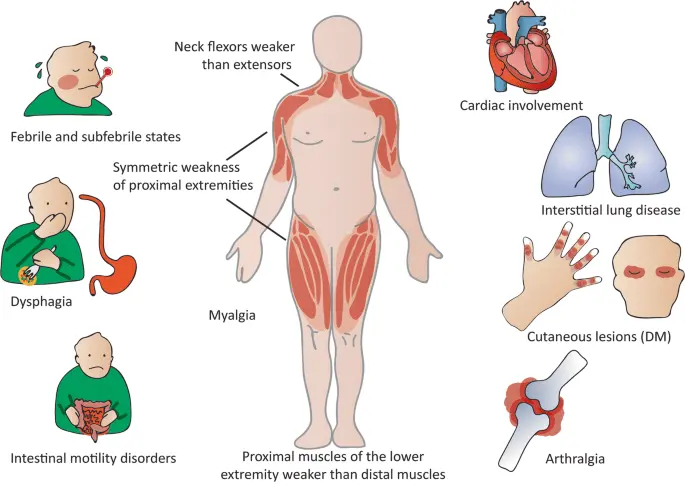 Myopathy &#8211; Causes and Symptoms. What is the treatment of myopathy?