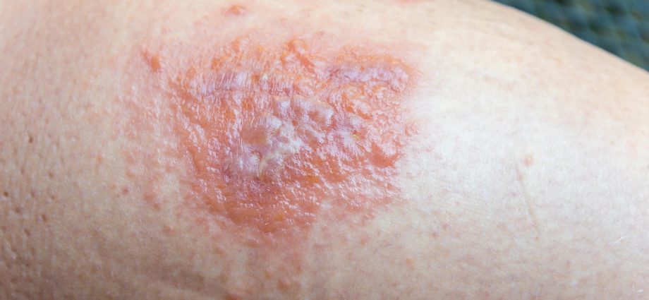 Mysterious rash