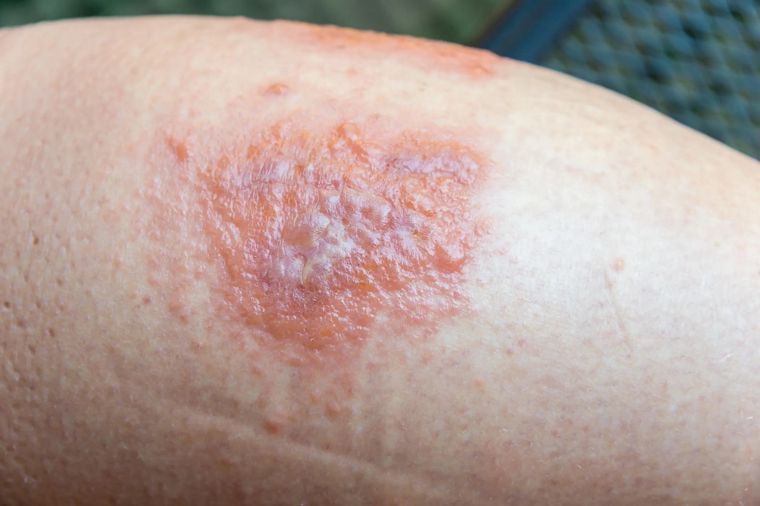 Mysterious rash