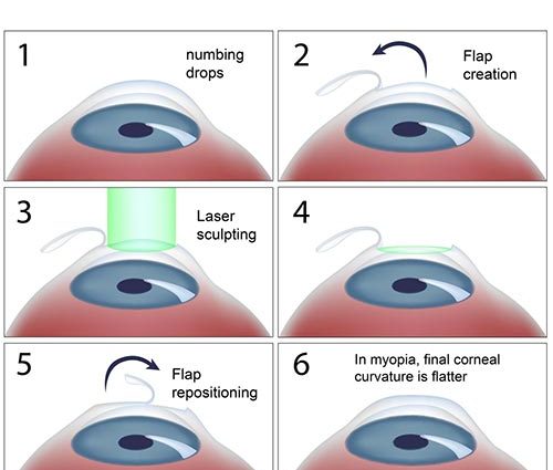 Myths about laser vision correction