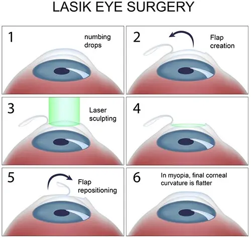 Myths about laser vision correction