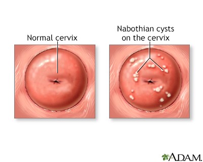 Naboth&#8217;s cysts &#8211; what are they and do they need to be treated?