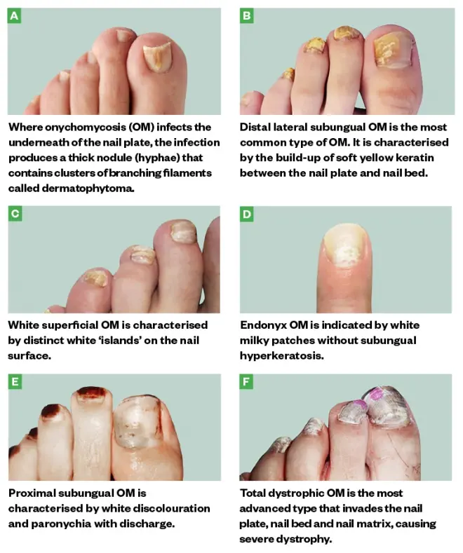 Nail fungus &#8211; types, causes, treatment, prevention [EXPLAINED]