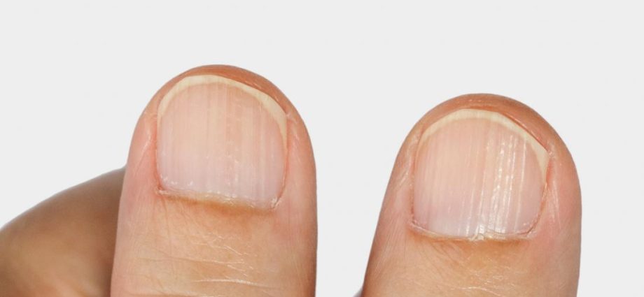 Nail grooves &#8211; causes, types, treatment