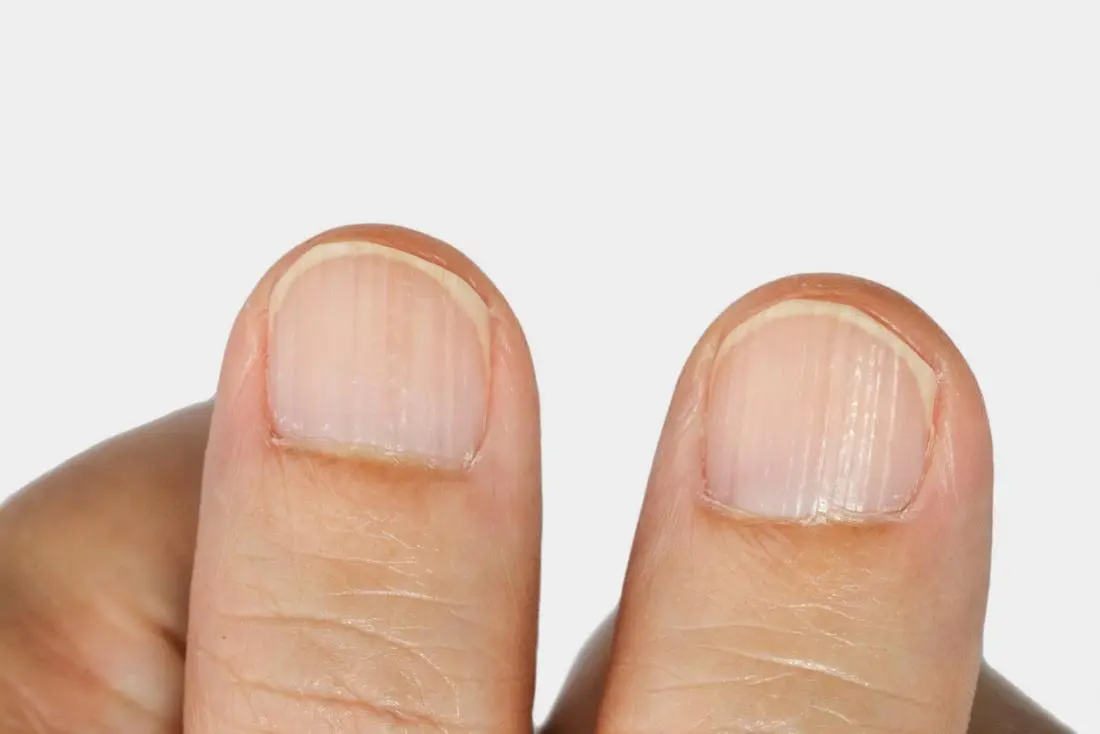 Nail grooves &#8211; causes, types, treatment