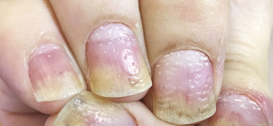 Nail psoriasis &#8211; causes, symptoms, treatment