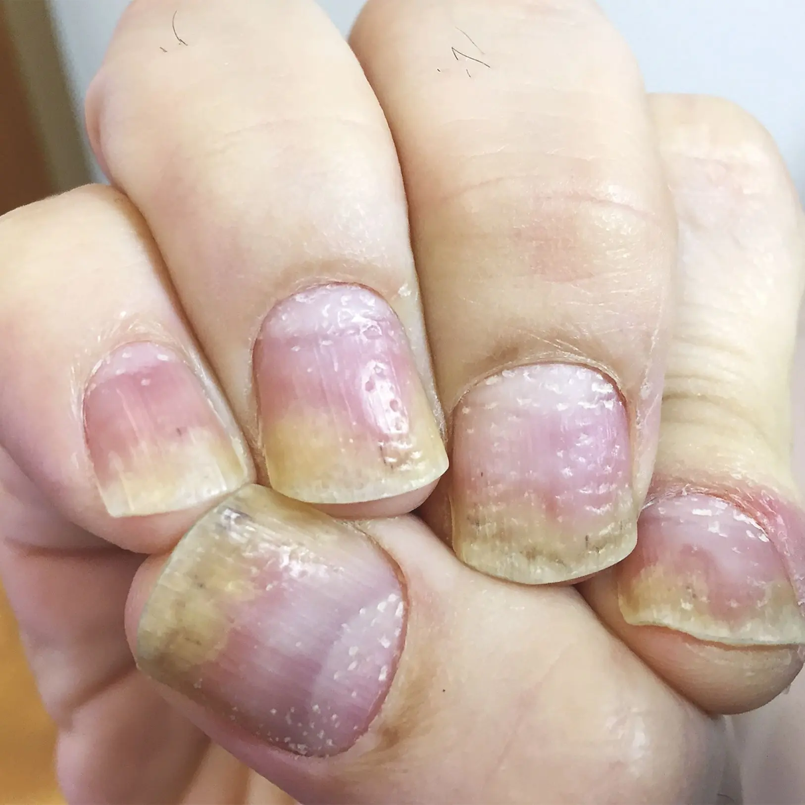 Nail psoriasis &#8211; causes, symptoms, treatment