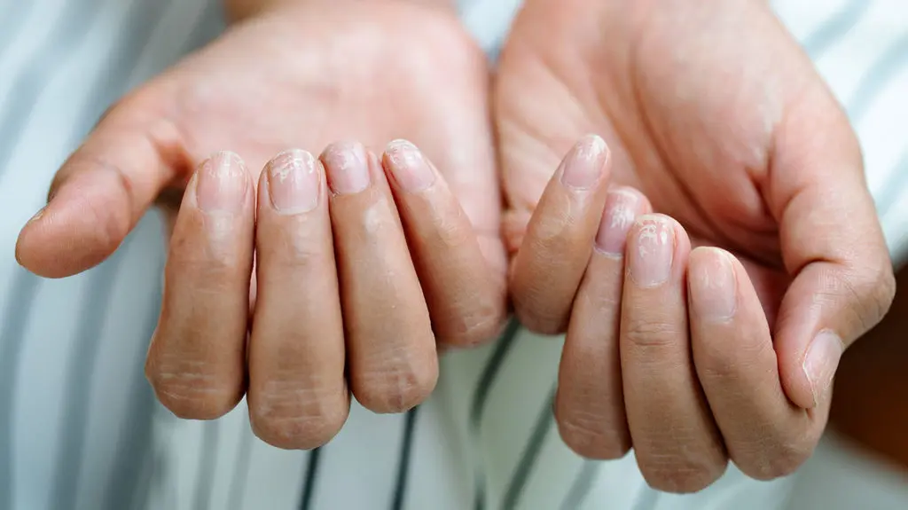 Nails and health. What can brittle nails mean?