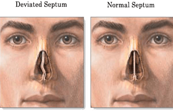 Nasal septum surgery &#8211; description of the procedure and convalescence