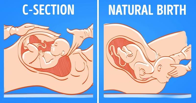 Natural childbirth or Caesarean?