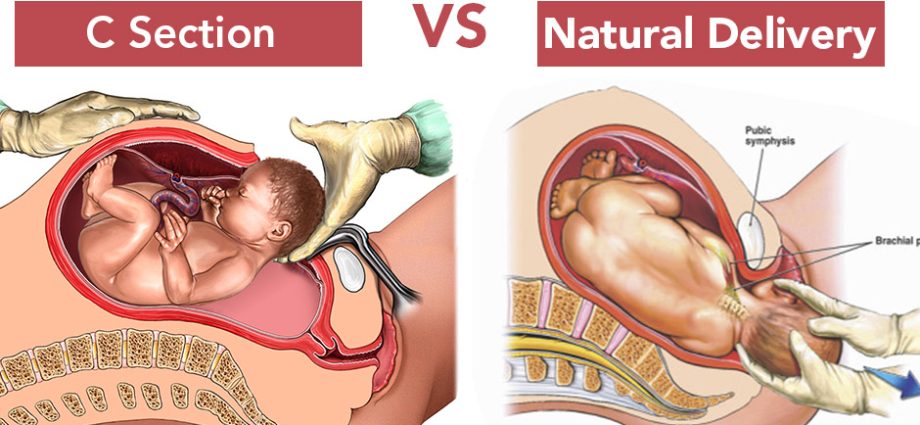 Natural childbirth &#8211; preparation, course, advantages, complications. Natural childbirth after caesarean section