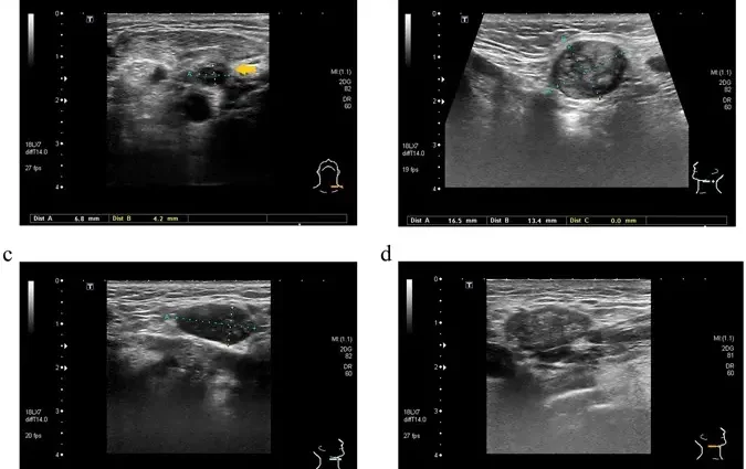 Neck ultrasound &#8211; what can it detect and when is it indicated?