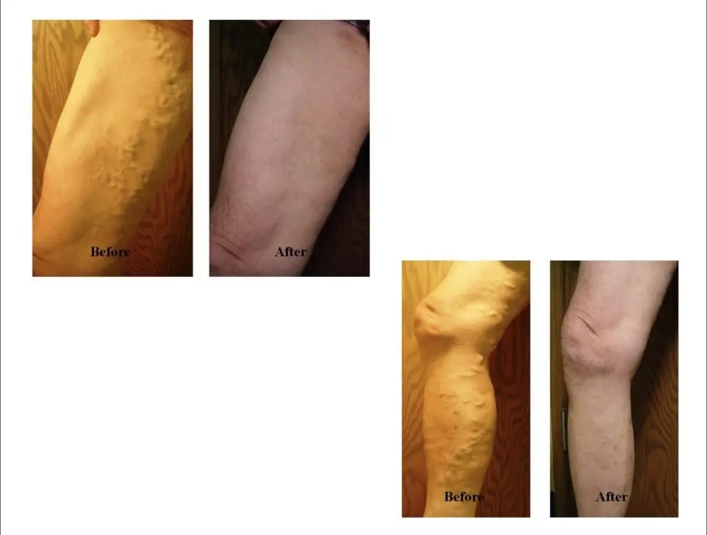 Neglecting varicose veins of the lower extremities