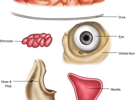 Neoplasms of the nose and paranasal sinuses