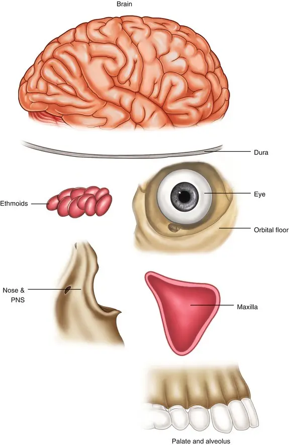 Neoplasms of the nose and paranasal sinuses