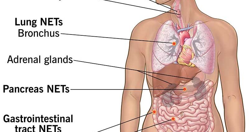 NET tumors: tumors that pretend to be other diseases