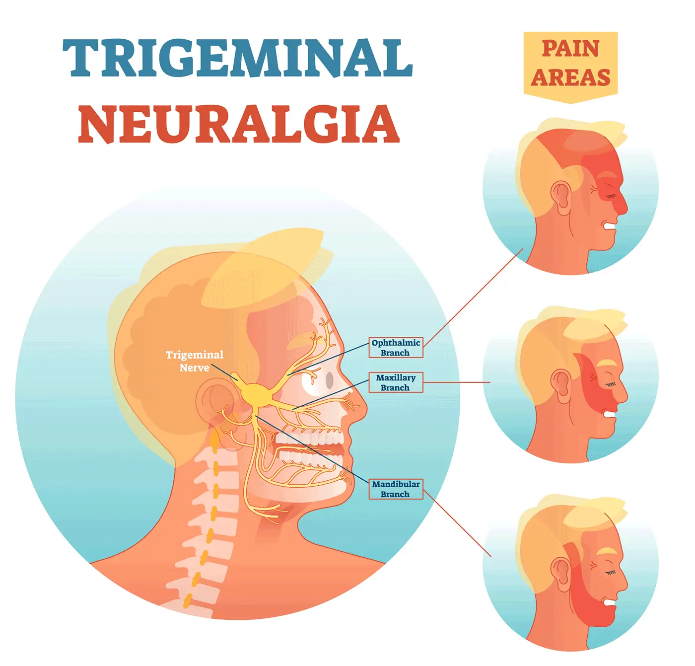 Neuralgia of the trigeminal nerve &#8211; symptoms, causes, treatment. In what neighborhoods does it attack?