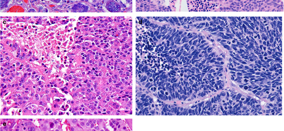 Neuroendocrine tumors &#8211; a latent, atypical neoplasm