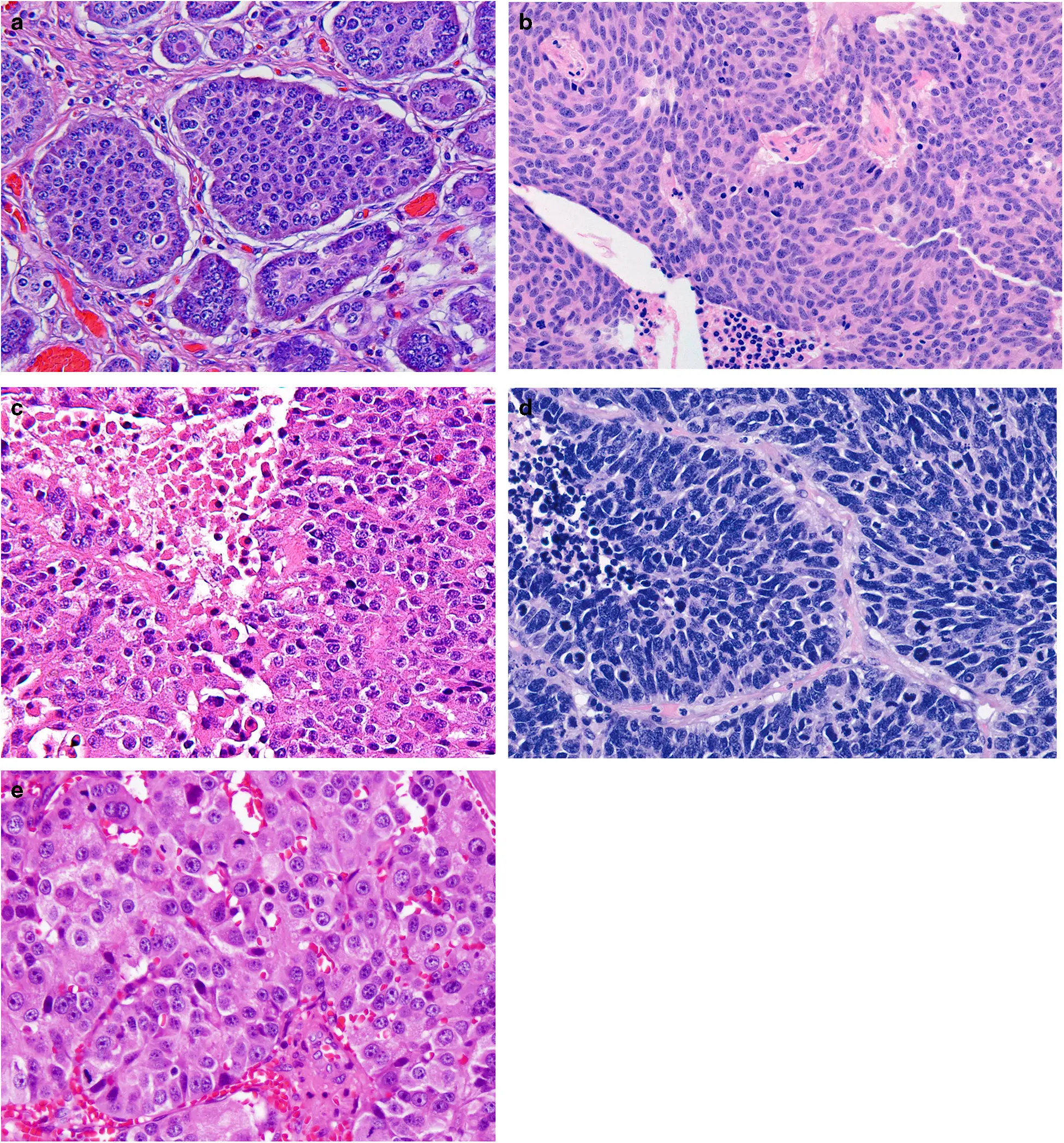 Neuroendocrine tumors &#8211; a latent, atypical neoplasm