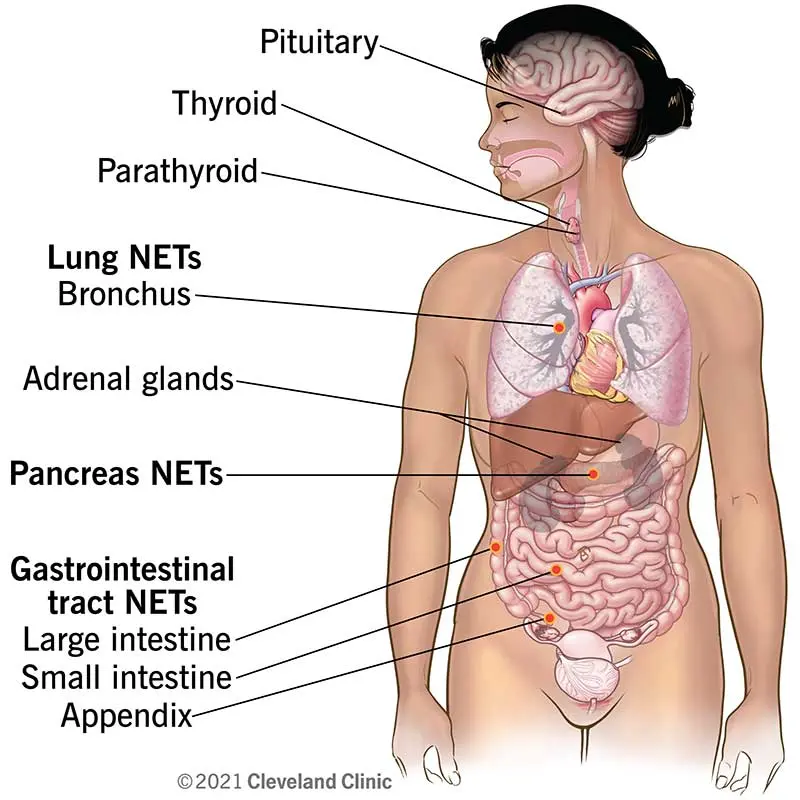 Neuroendocrine tumors &#8211; difficult diagnosis and ambiguous symptoms. What can they be confused with?