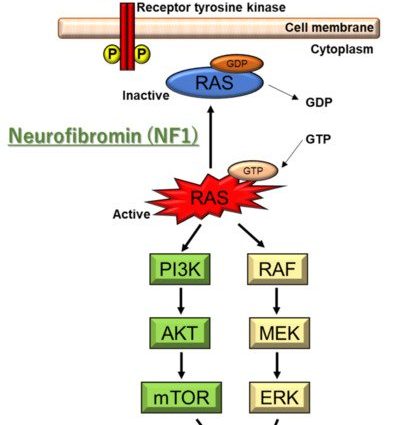 Neurofibromatosis &#8211; deforming genetic disease. Diagnostics and treatment