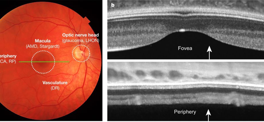 New methods of restoring the quality of vision