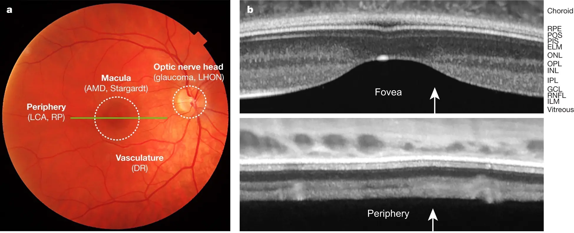 New methods of restoring the quality of vision