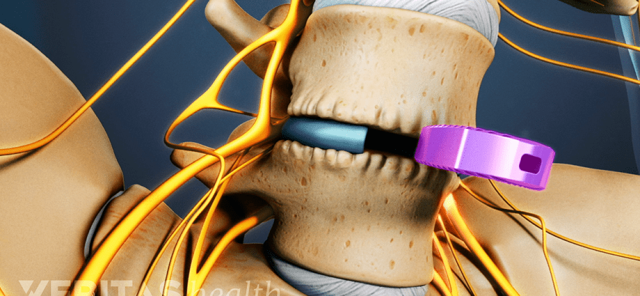 New methods of treating discopathy