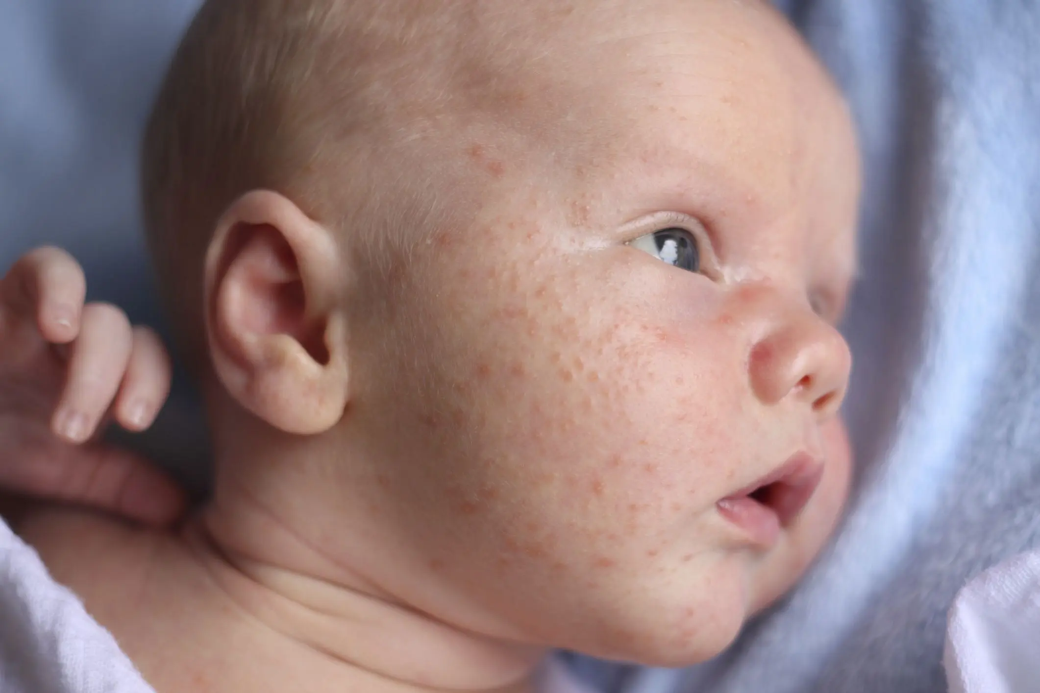 Newborn acne