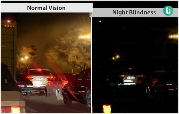 Night blindness &#8211; symptoms, causes, treatment