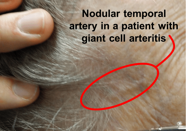 Nodular arteritis