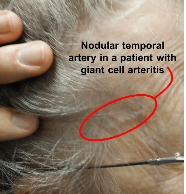 Nodular arteritis