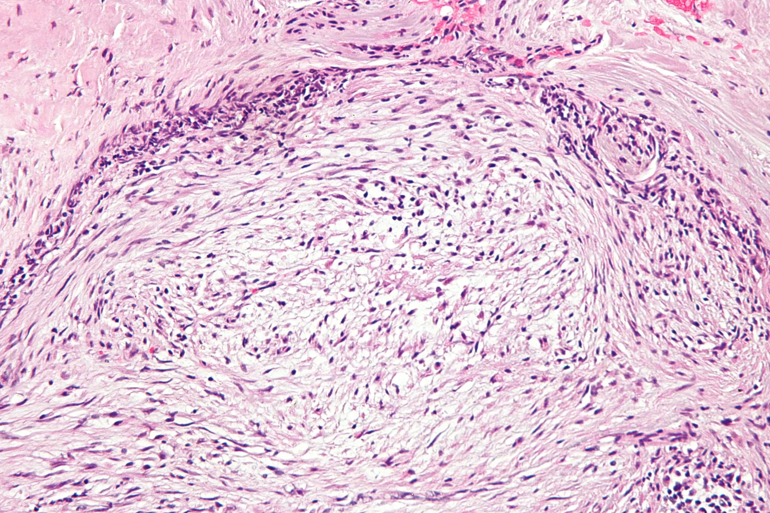 Nodular fasciitis