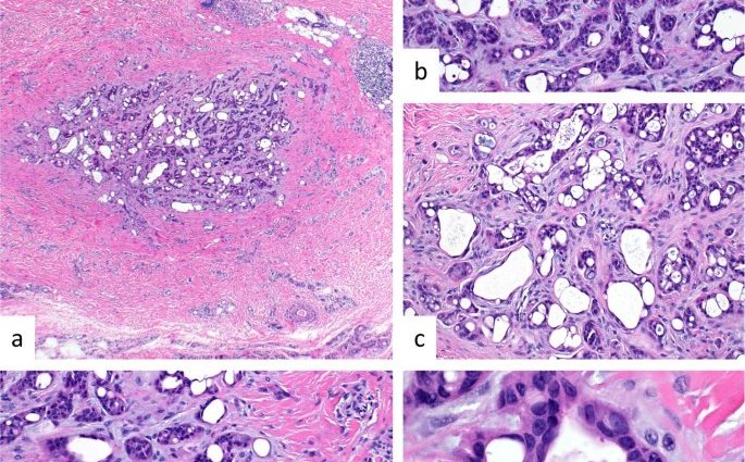 Nodular sweat adenoma &#8211; what it looks like, treatment, prognosis