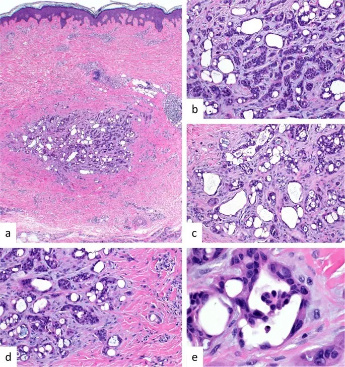 Nodular sweat adenoma &#8211; what it looks like, treatment, prognosis